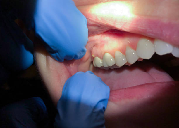 Best Emergency Root Canal Treatment in Washington, MO