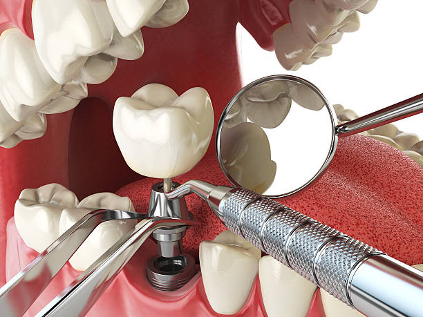 Best Emergency Root Canal Treatment in Washington, MO